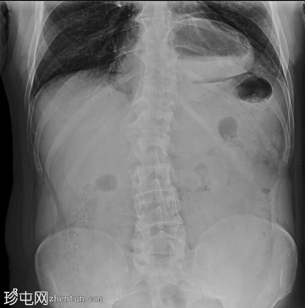 急腹症伴食管裂孔疝