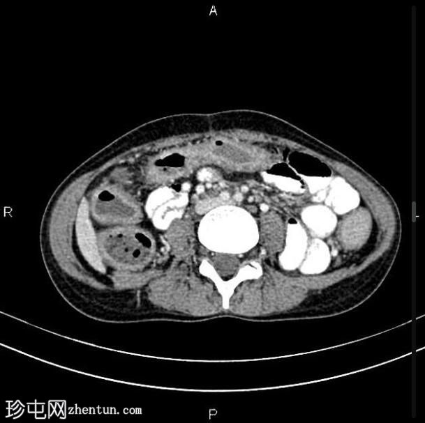全结肠炎