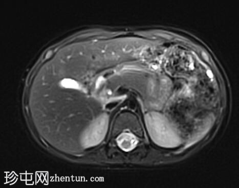 胆总管囊肿 - 1 型