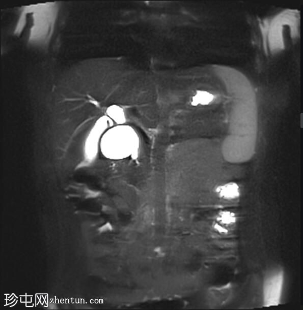 胆总管囊肿 - II 型