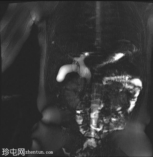 胆总管囊肿 - 4a 型