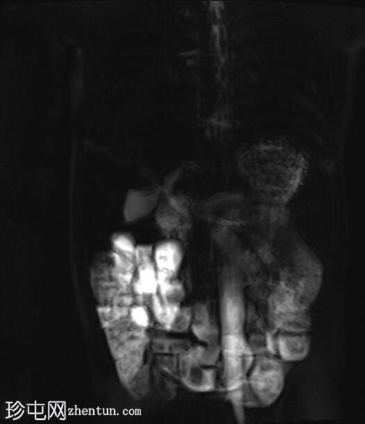胆总管囊肿 - 1A 型