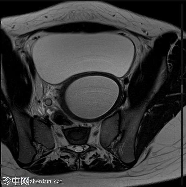 阴道闭锁伴子宫阴道积血、异位右输尿管和多囊性发育不良右肾