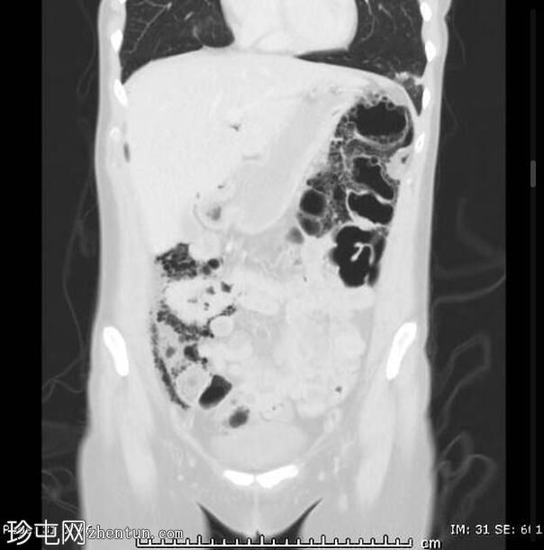 大肠杆菌气病