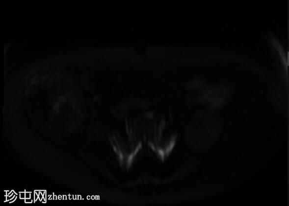 回肠套叠 - 脂肪瘤引导点