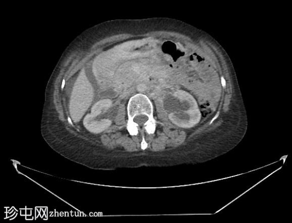 乳腺癌的跨体腔扩散