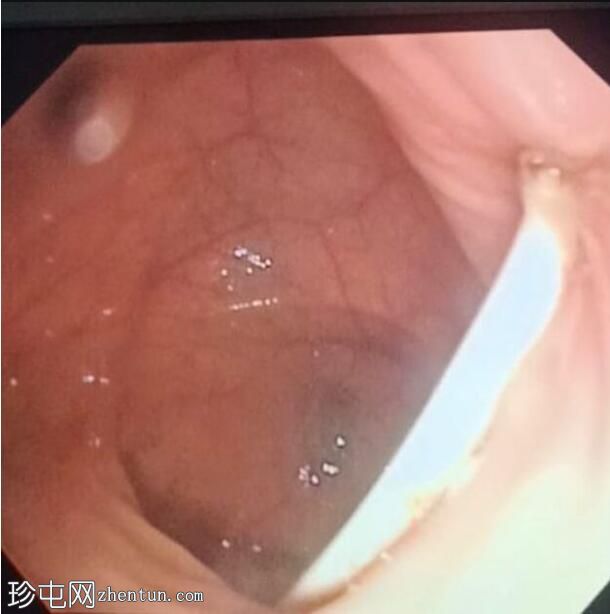 脑室-腹腔分流术向结肠的迁移