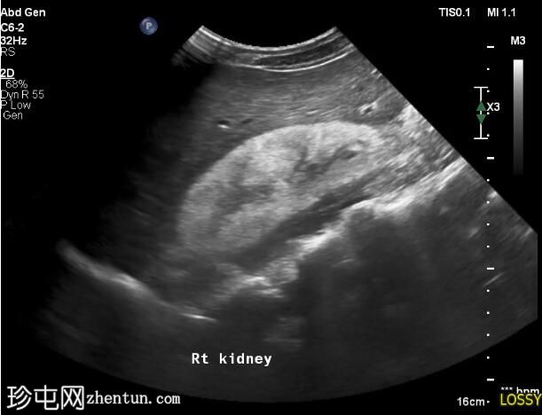 HIV相关肾病和腹部结核