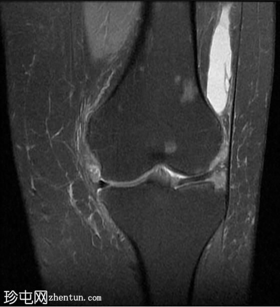 膝关节弥漫性腱鞘巨细胞瘤