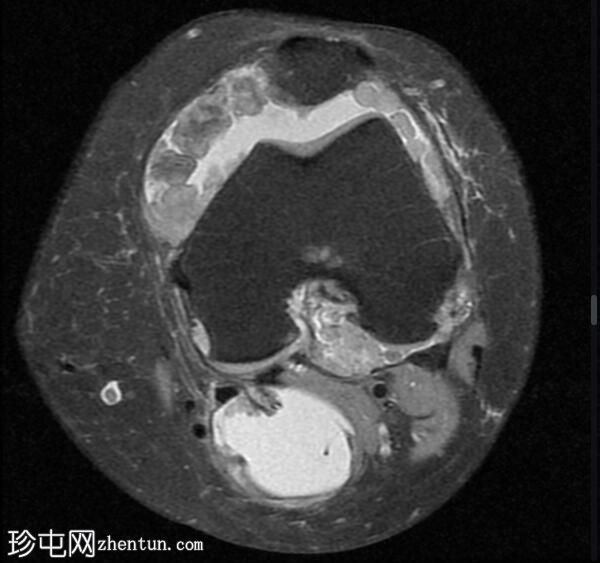 膝关节弥漫性腱鞘巨细胞瘤