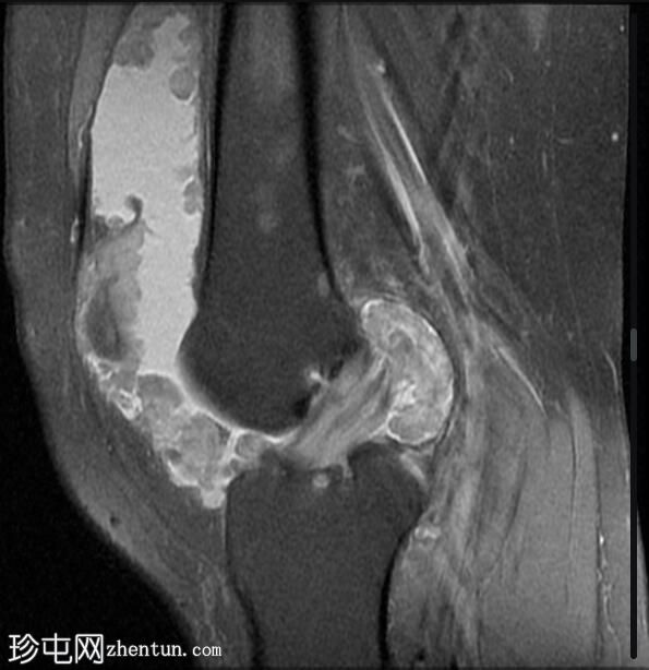 膝关节弥漫性腱鞘巨细胞瘤