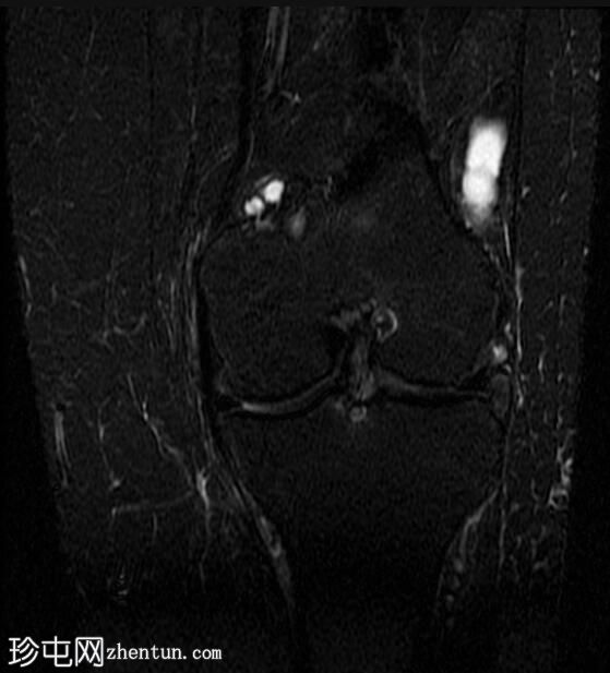 膝关节弥漫性腱鞘巨细胞瘤