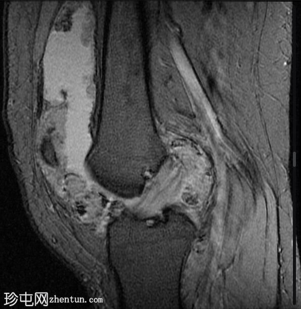 膝关节弥漫性腱鞘巨细胞瘤