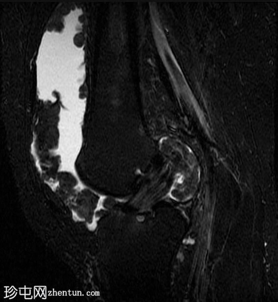 膝关节弥漫性腱鞘巨细胞瘤