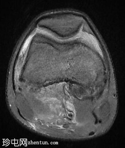 膝关节弥漫性腱鞘巨细胞瘤