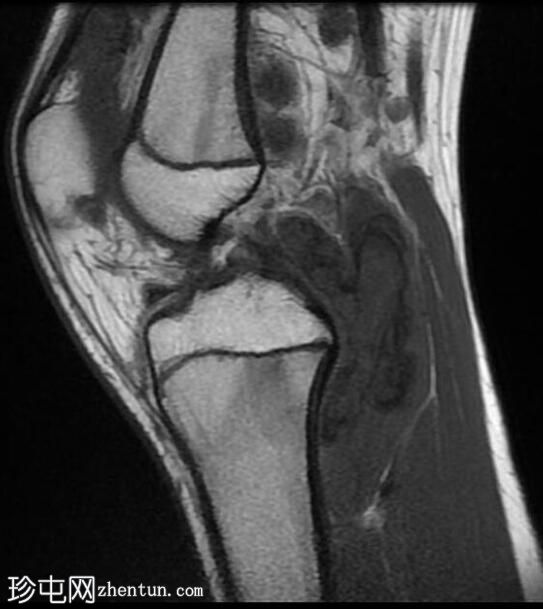 膝关节弥漫性腱鞘巨细胞瘤