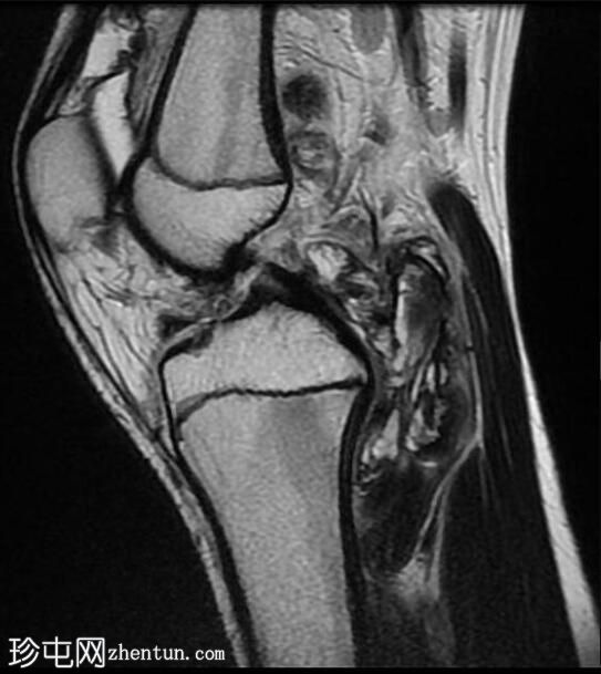 膝关节弥漫性腱鞘巨细胞瘤