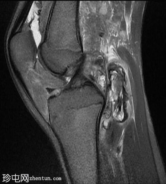 膝关节弥漫性腱鞘巨细胞瘤