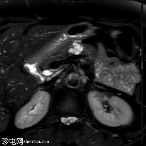 导管内乳头状粘液性肿瘤（IPMN）