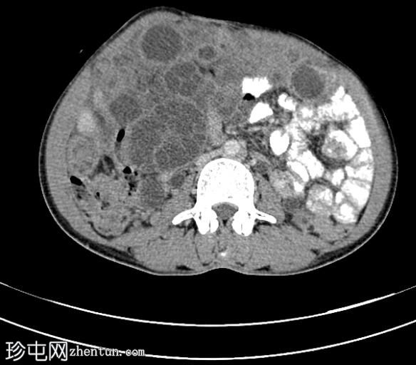 播散性腹膜包虫病