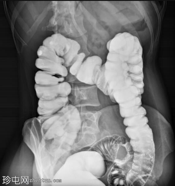 乙状结肠腺癌