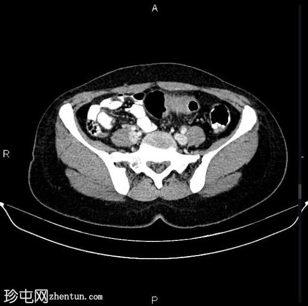 乙状结肠腺癌