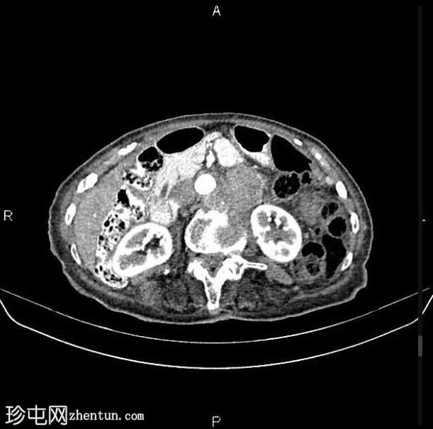 转移性直肠腺癌