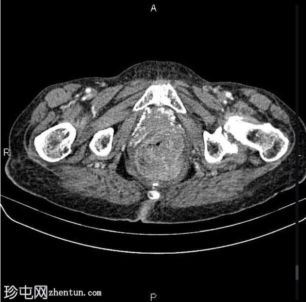 转移性直肠腺癌