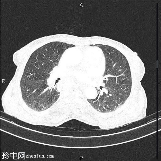 转移性直肠腺癌