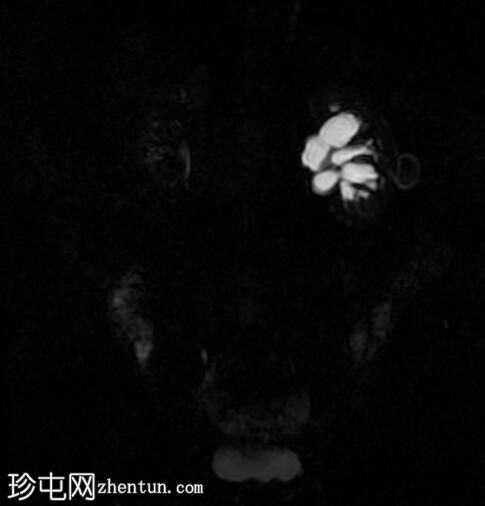 盆腔周围囊肿和假性肾积水