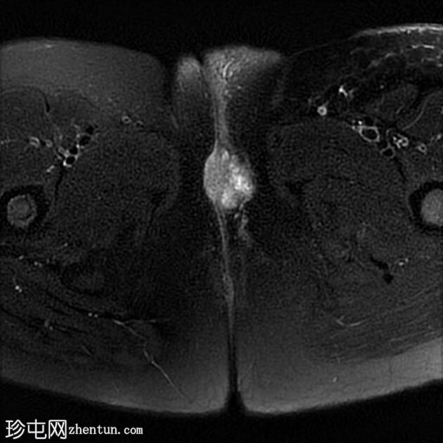 外阴鳞状细胞癌