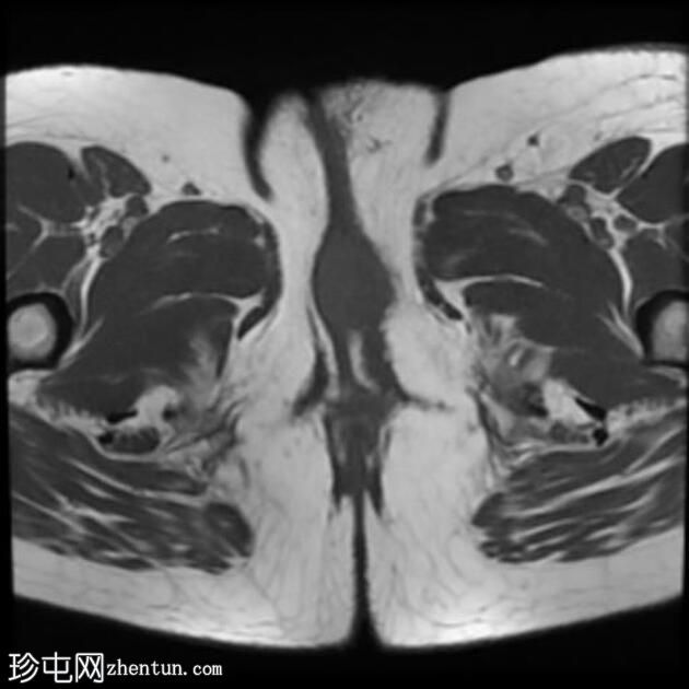外阴鳞状细胞癌