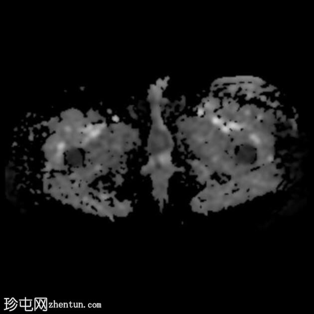 外阴鳞状细胞癌