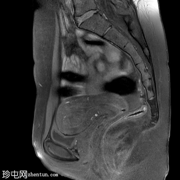 粘膜下子宫肌瘤