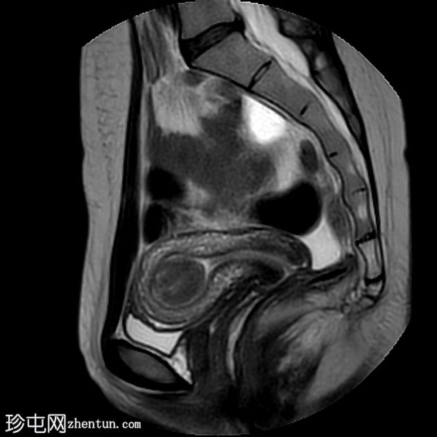 粘膜下子宫肌瘤