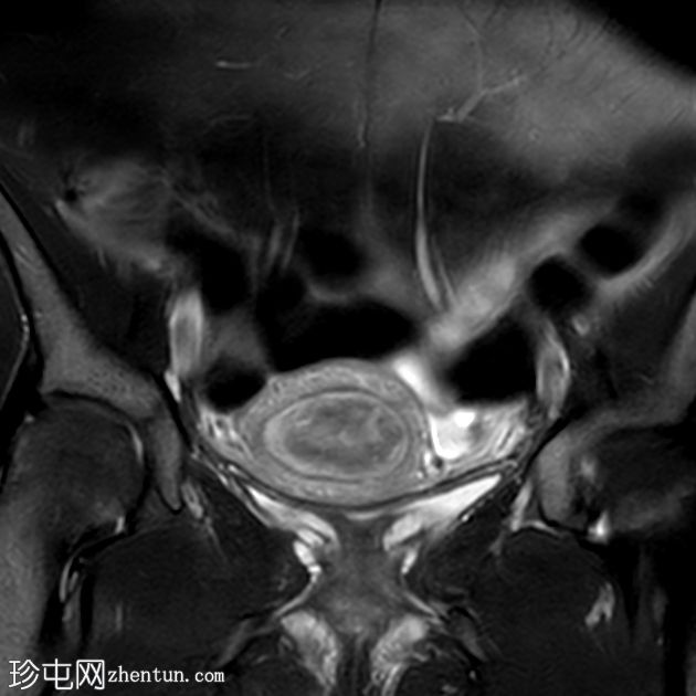 粘膜下子宫肌瘤