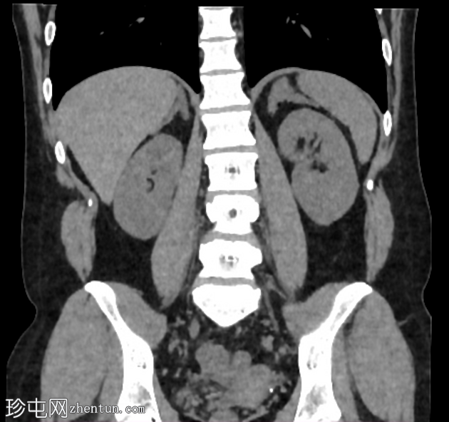 先天性肾上腺增生症