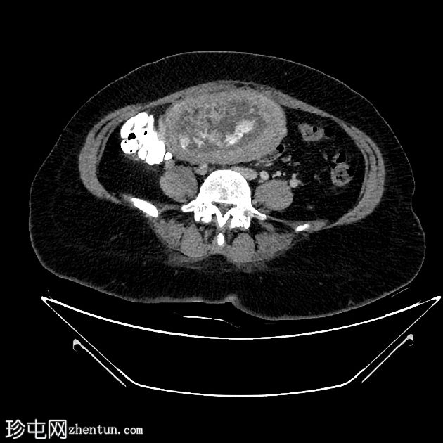 妊娠滋养细胞疾病（GTD）
