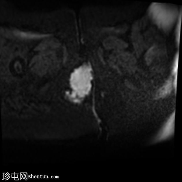 源自肛周瘘的肛周黏液腺癌