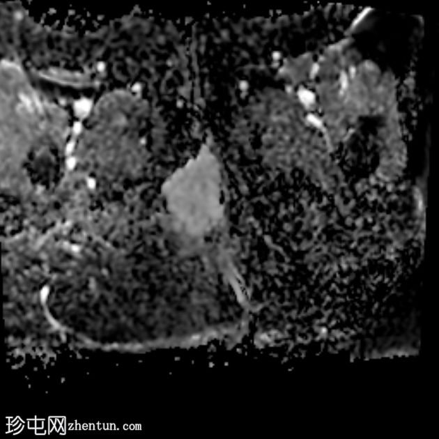 源自肛周瘘的肛周黏液腺癌