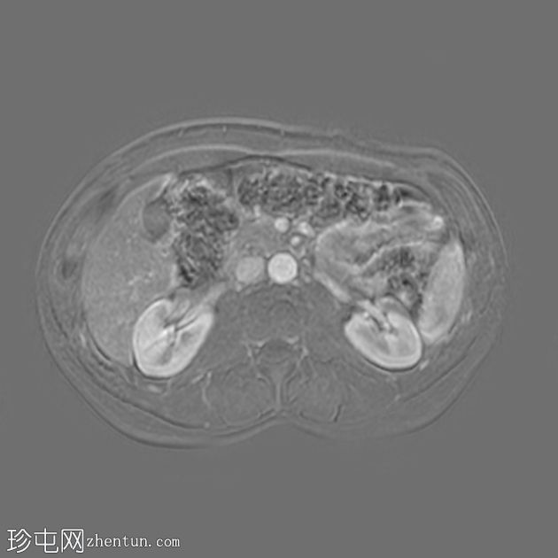 类似胰腺肿块的脾动脉假性动脉瘤