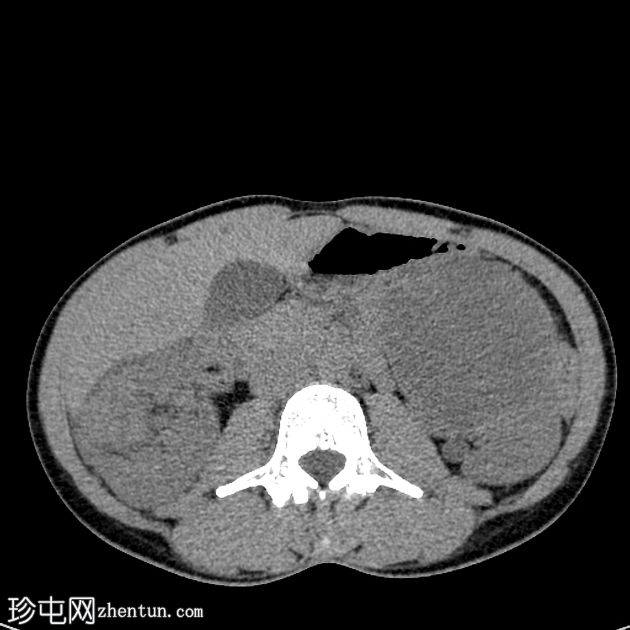 双侧肾细胞癌