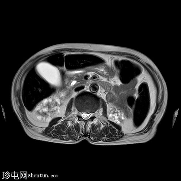 获得性囊性肾病