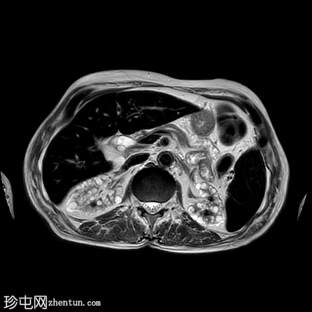 获得性囊性肾病