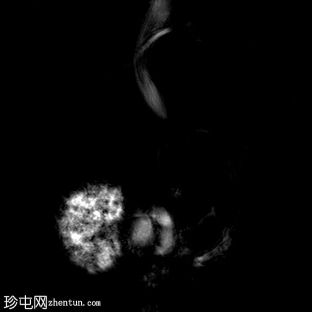 获得性囊性肾病