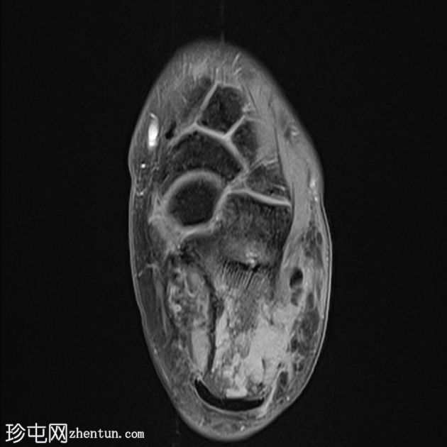 跟骨芽生菌病