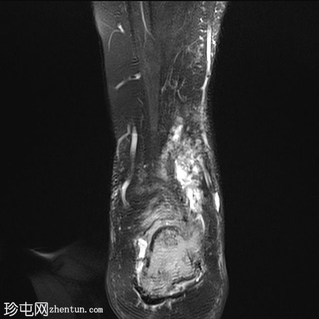 跟骨芽生菌病