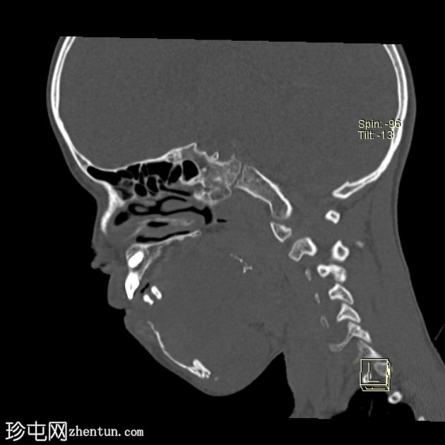 下颌骨纤维增生症