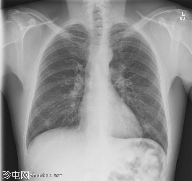 通过乳头标记确认双侧乳头密度