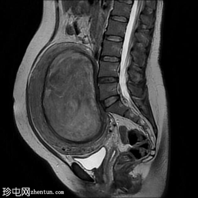 大型子宫平滑肌瘤伴有红色变性